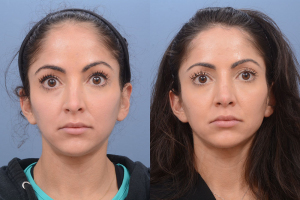 Forehead Reduction